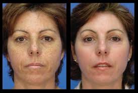 MicroLaser Peel — StrotherDermatology.com