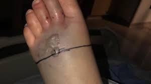 The manufacturer, red rock biologics shows no study data to support efficacy at all. Fresno Teen Recovers From Rattlesnake Bite Kmph