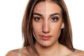 How To Get Rid Of Acne Scars 11 Top Treatments Bioclarity