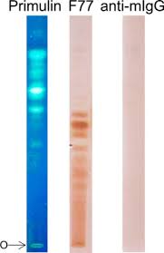 Prostate cancer is the most common cancer in men after skin cancer, so it's important to understand the basics of the disease, as well as the risk factors. Carbohydrate Sequence Of The Prostate Cancer Associated Antigen F77 Assigned By A Mucin O Glycome Designer Array Journal Of Biological Chemistry