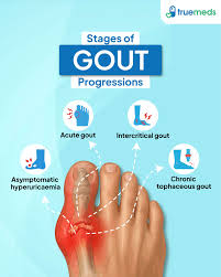 Image result for gout symptoms toe