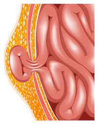 Fg Syndrome Medlineplus Genetics