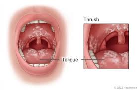 Image result for Strep throat infection roof of mouth