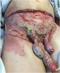 Fournier's gangrene is even rarer in. Extensive Necrotizing Fasciitis From Fournier S Gangrene Sciencedirect