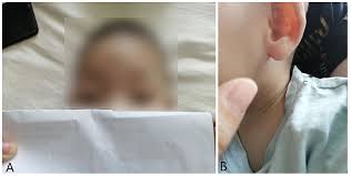 Partial deletion of the distal part of the short armof chromosome 3 was first reported by verjaal andde nef in 1978. Frontiers Case Report A Case Report And Literature Review Of 3p Deletion Syndrome Pediatrics