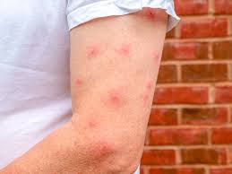 Image result for mosquito bite