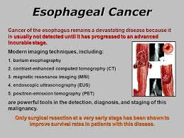 When to see a doctor. Esophageal Cancer Ppt Video Online Download