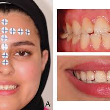 PDF) Dental implant placement with immersive technologies: A preliminary  clinical report of augmented and mixed reality applications