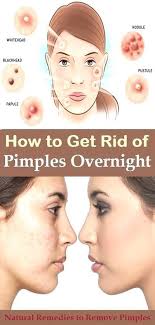 Best Way To Get Rid Of Acne Overnight Find Out How To Remove Pimples Naturally Overnight How To Get Rid Of Pimples How To Remove Pimples Pimples On Forehead
