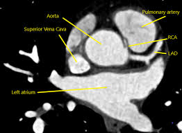 Being out of the ordinary. Cureus A Case Of Anomalous Origin Of The Right Coronary Artery From The Left Sinus Of Valsalva With A Malignant Course