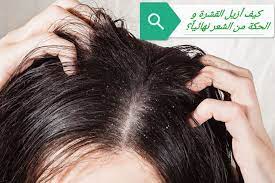 قشرة الرأس تعد من أكثر المشكلات المزعجة بالنسبة للكثير من الناس فكيف أزيل القشرة و الحكة من الشعر نهائيا هذا ما سنت Hair Dandruff Dandruff Treatment Dandruff