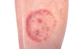 Rasa gatal yang muncul akibat kudis atau scabies biasanya lidah buaya memiliki sifat kuratif yang sangat baik untuk merawat kulit gatal karena kudis. Bercak Merah Di Kulit Bikin Gak Pede Kenali Tanda Dan Cara Mengobatinya Cermati Com