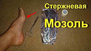 как вывести сухой мозоль со стержнем на пальце ноги Shipica Podoshvennaya Mozol So Sterzhnem Kak Lechit Mozoli Vse Eto Sginet Na Net Navsegda Ot Folgi Youtube