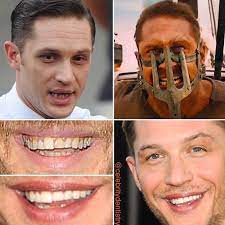 Celebrity Dentistry on Instagram: “Tom Hardy is a rising star in Hollywood,  although his smile is less than what mos… | Dentistry, Cosmetic dentistry,  Perfect teeth