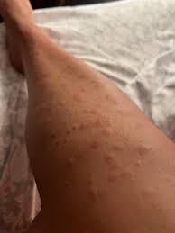 Image result for allergy rash on the legs
