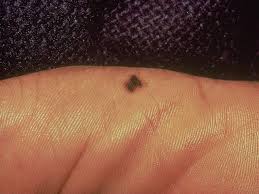 When malignant cancer cells form and grow within a person's breast tissue, breast cancer occurs. Is It Skin Cancer Cbs News