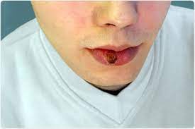 Syphilis is a sexually transmitted infection causing sores on the genitals. Syphilis Symptoms