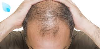 Intralesional treatment of alopecia areata with triamcinolone acetonide by jet injector. Alopecia L Azione Positiva Dei Protocolli Di Medicina Rigenerativa Alopecia24