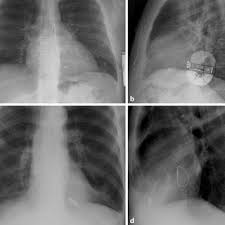 We did not find results for: Pdf Sichere Mrt Untersuchung Bei Patienten Mit Herzschrittmacher Und Icdsafe Mri Examinations In Patients With Pacemakers And Icd