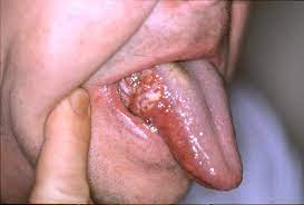 Sometimes cancer is advanced when it is first diagnosed. Oral Cancer Wikipedia