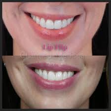 The Hottest New Trend Botox Lip Flip Charmed Medispa