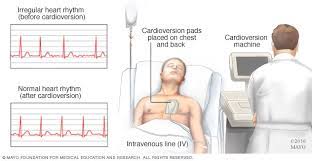 Sinus rhythm persisted in 89.9% of patients at 24 h after cardioversion, in 54.1% at 1 month and in 49.0% of patients at 3 months after cardioversion. Cardioversion Mayo Clinic