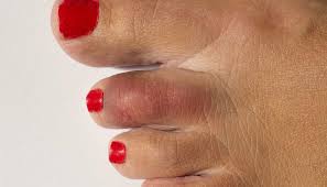 Your big toe is likely going to be a bigger problem than my small toe. Broken Toe Symptoms Pictures And Treatment
