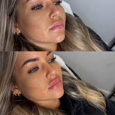 1ml lip filler top up