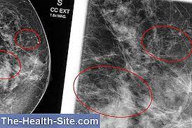 Ductal carcinoma in situ of the breast: Carcinom Ductal In Situ Dcis Diagnostic Tratament ÈtiinÈifico Practic Medical Journal 2021