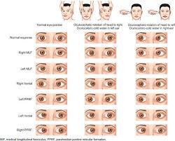 Image result for Oculovestibular Testing