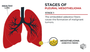 Pleural mesothelioma is a rare type of cancer that causes the abnormal and malignant cell growth of the pleural layer of the lungs. Mesothelioma Lawyers Asbestos Exposure Elg Law