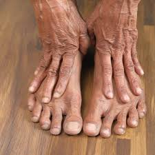 Image result for brown patches on the feet