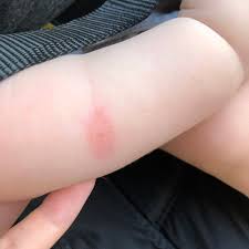 Image result for bedbugs bites