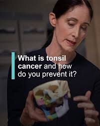 Tonsil cancer is a type of head and neck cancer. Cancers that arise in the  tonsils or back of the tongue are classified as oropharyngeal cancer, and  most of these (approximately 70%)