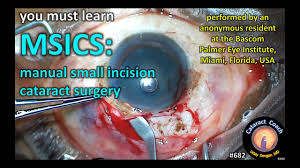 Msics Manual Small Incision Cataract Surgery Youtube
