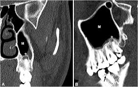 Image result for Maxillary Sinus