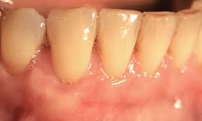 Mar 02, 2016 · gum disease eventually makes teeth loose and fall out. Gum Regeneration Zahnarztpraxis Dr Zimmer Munchen