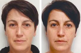 INDIBA® EDNA PRO MAX