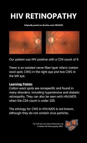 Image result for HIV Retinitis