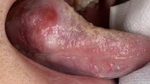 oral potentially malignant disorders ...