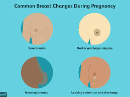 It may occur in both breasts. Breast Changes During Pregnancy