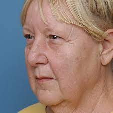 When people get old, the energy level decreases day by day. A 60 Year Old Woman Who Is Markedly Overweight And Recently Underwent Download Scientific Diagram