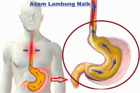 Lalu, cara mengobati asam lambung secara alami seperti apa yang ampuh dan sudah terbukti efektif? Cara Mengobati Asam Lambung Secara Alami Qnc Jelly Gamat Medium