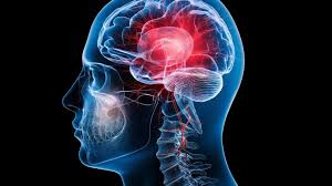 Image result for Brain Lesion