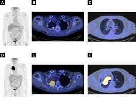 What is pixel experience rom? Predictive And Prognostic Role Of Metabolic Response In Patients With Stage Iii Nsclc Treated With Neoadjuvant Chemotherapy Clinical Lung Cancer