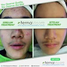 💕💕💕Mengatasi jerawat dan scar di wajah sekaligus Menjadikan Wajah Cerah  dan Glowing💕💕💕, Percayakan pada kami @eternamoore , dan masih banyak  lagi treatment