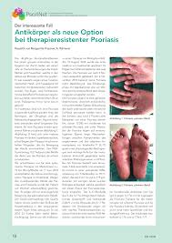 Der Interessante Fall Antikorper Als Neue Option Bei Therapieresistenter Psoriasis Rosenfluh Ch
