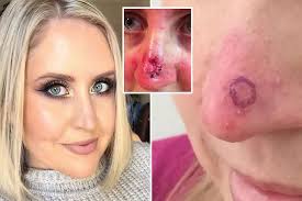 Skin cancer is by far the most common type of cancer. Skin Cancer Married At First Sight Star Reveals Tiny Pimple On Her Nose Was Acutally Skin Cancer