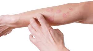 Herpes Labial Et Zona Differences Origine Et Traitements