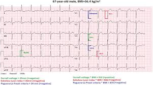 I dont know if they are outdated. Optimized Electrocardiographic Criteria For The Detection Of Left Ventricular Hypertrophy In Obesity Patients